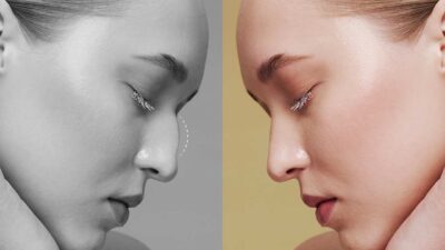 Burun estetik ameliyatı özelde paralı peki devlette ücretsiz mi? Devlet